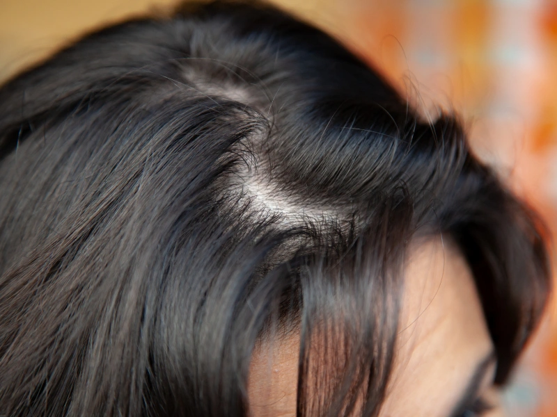 Keravive Treatment
