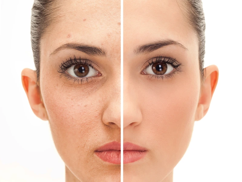chemical peel before after