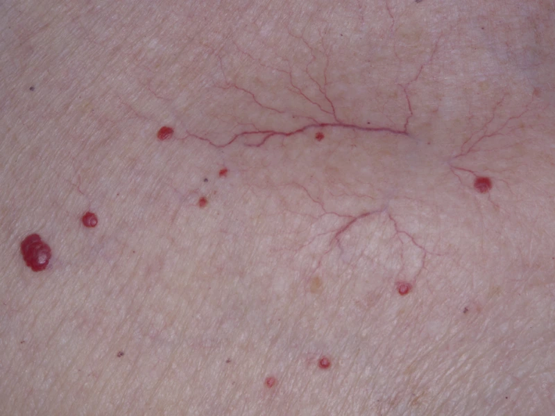 cherry angioma results