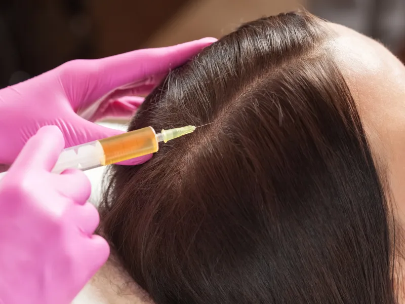 cost of prp microneedling for hair