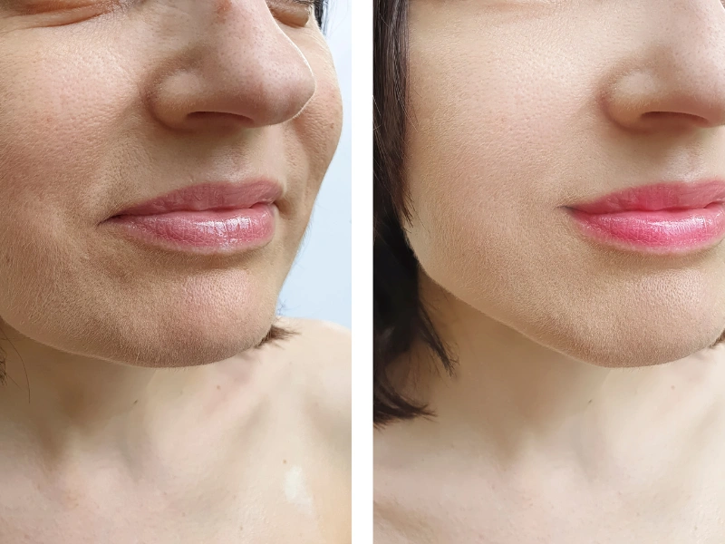 hydrafacial lymphatic drainage before and after