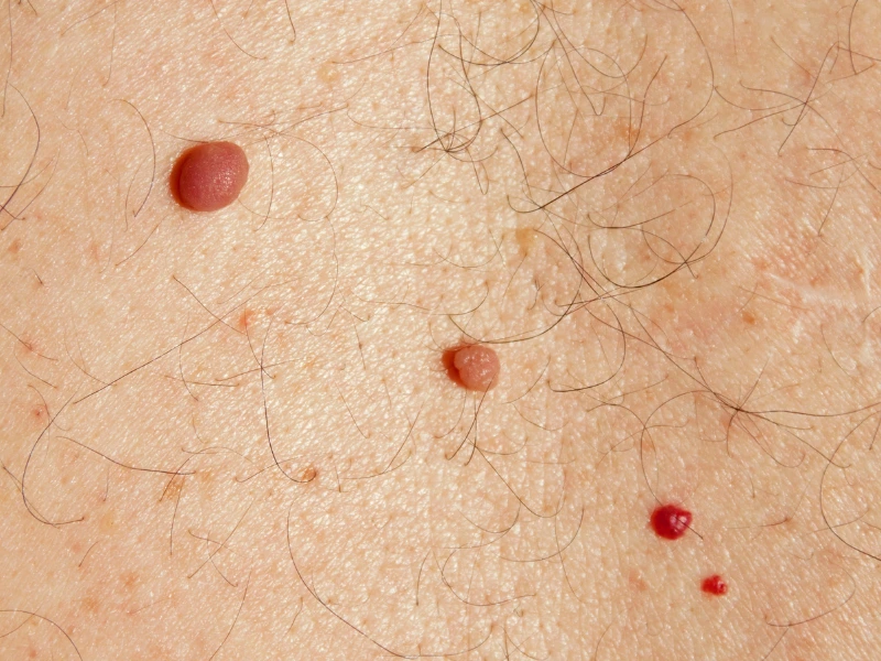 laser genesis xeo for cherry angioma