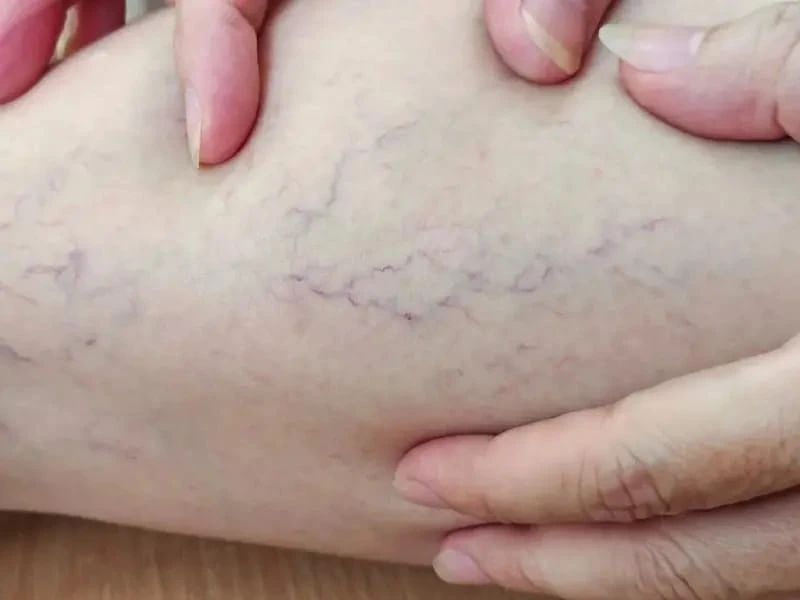 laser spider vein removal
