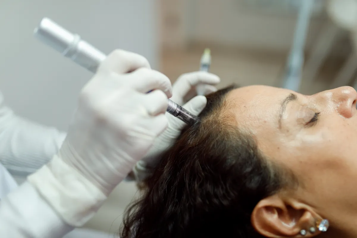 prp microneedling for hair