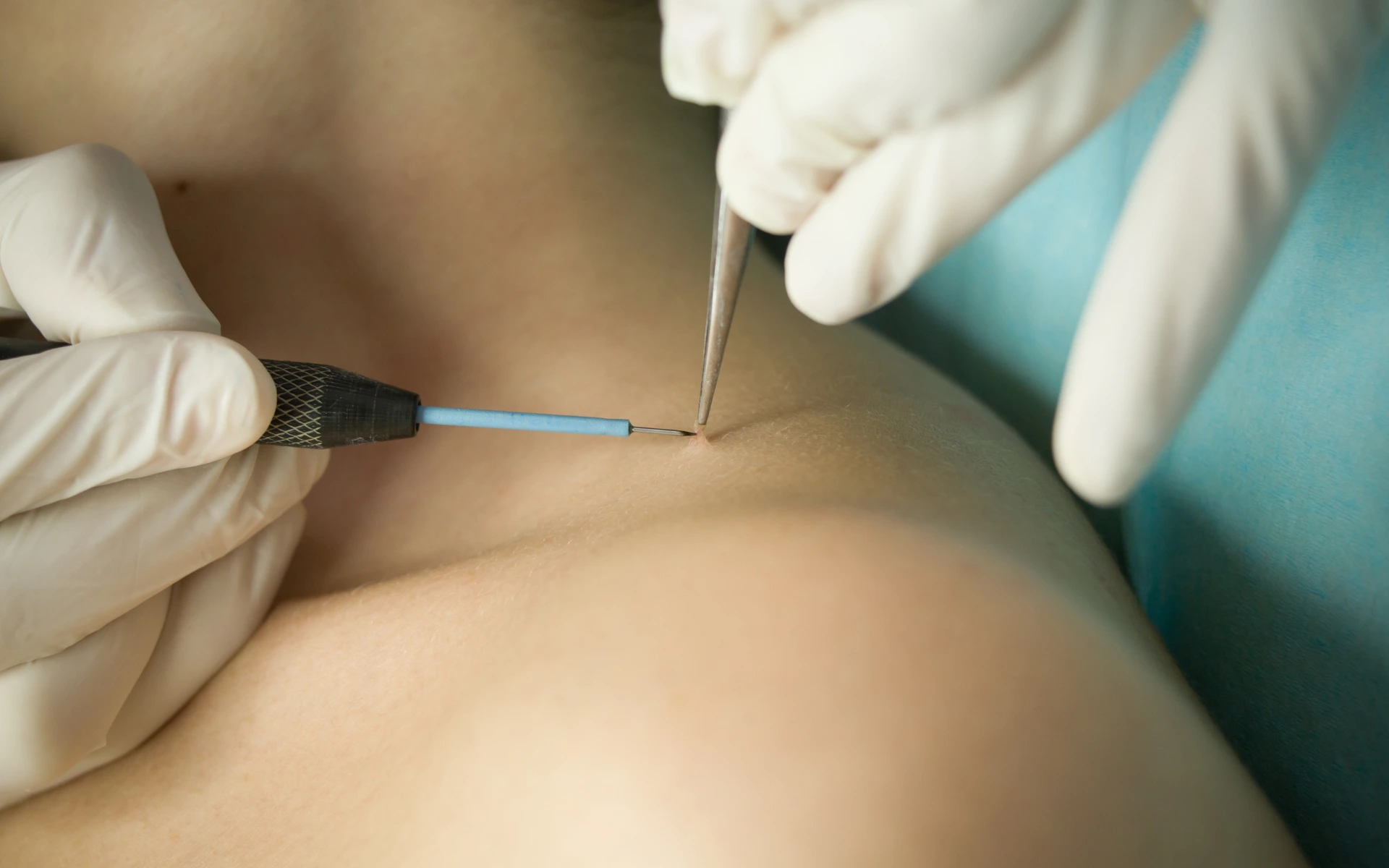 skin tag removal in houston tx