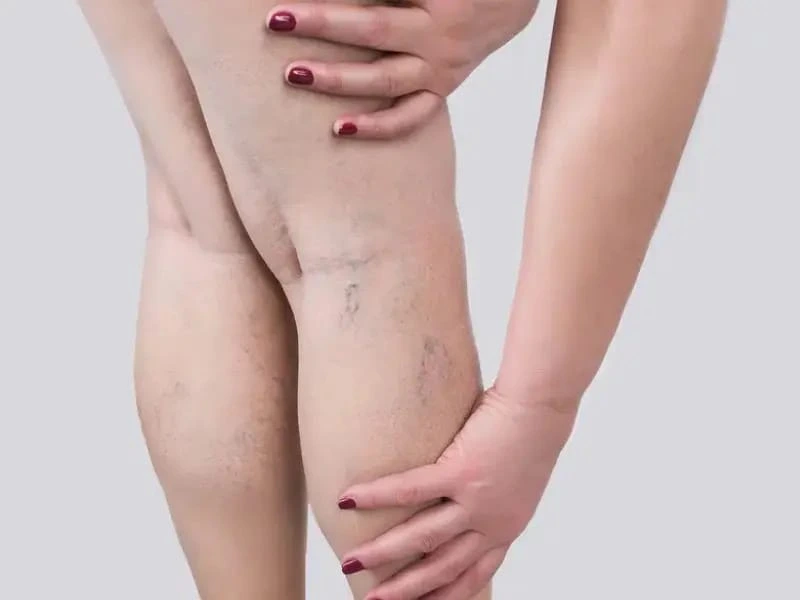 spider vein removal in houston tx