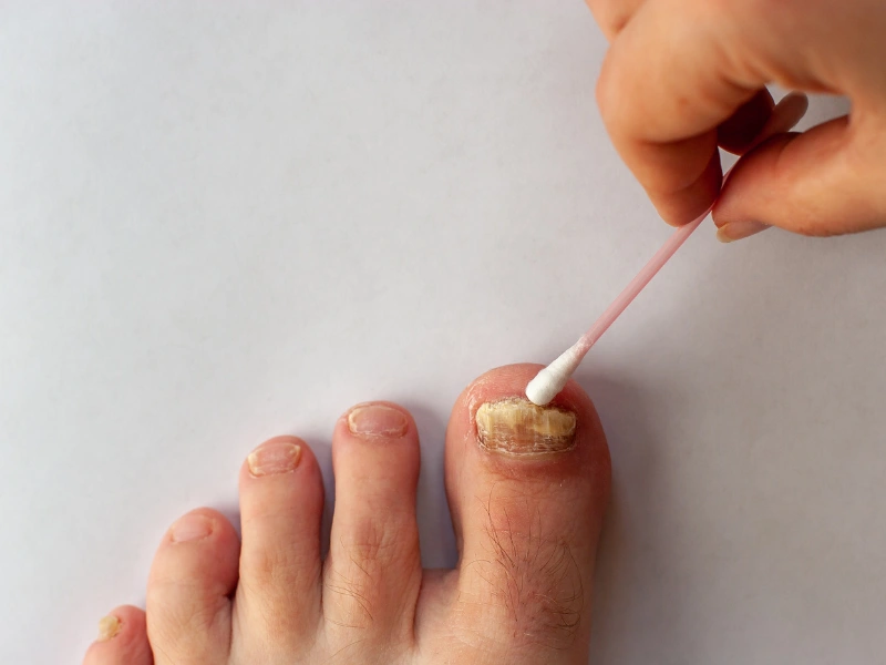 toenail fungus treatment cost