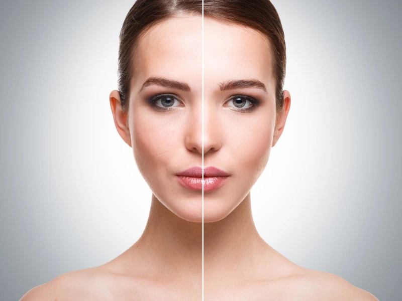 vi peel before and after