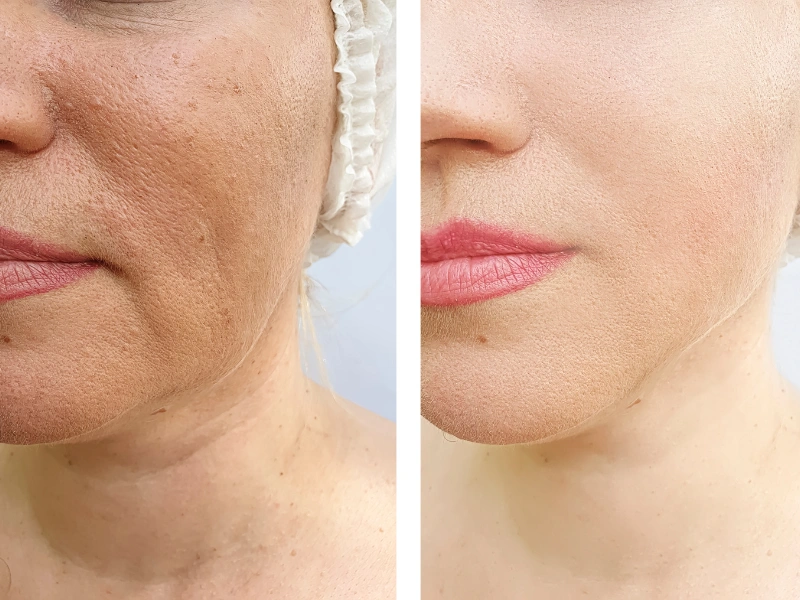vitamin b12 shots before and after