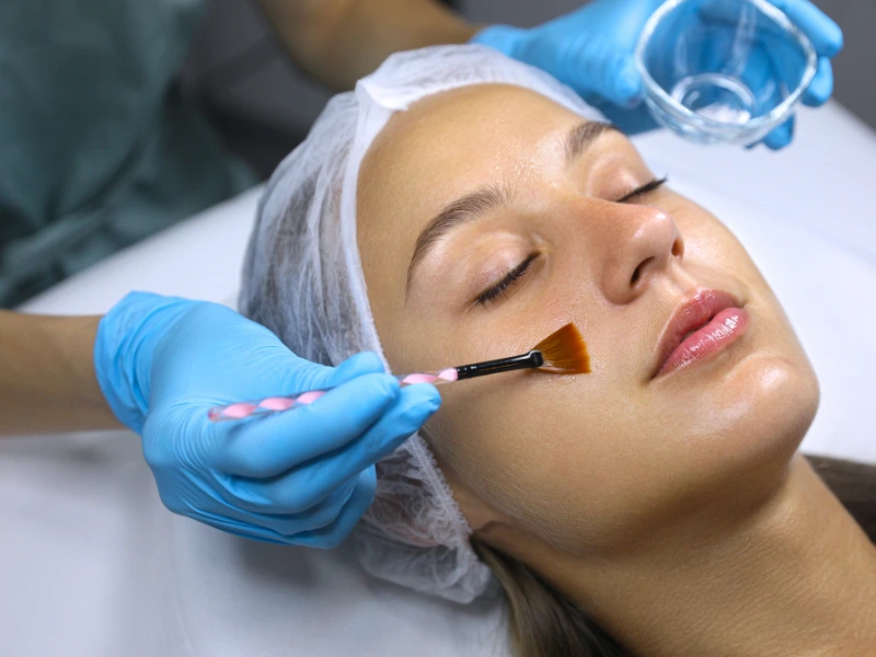 what is a vi peel
