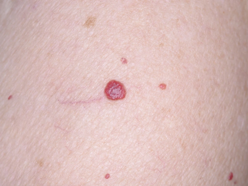 what is cherry angioma treatment