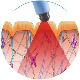 benefits of btl exilis