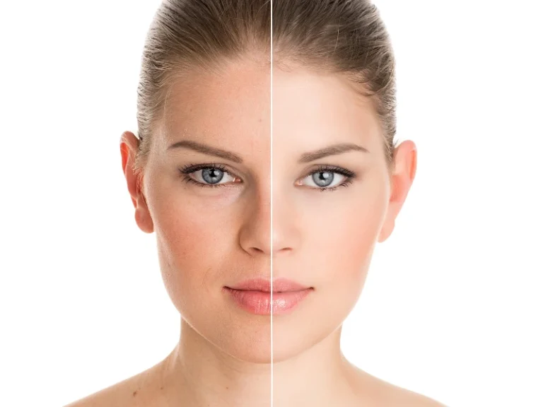 led light therapy before and after