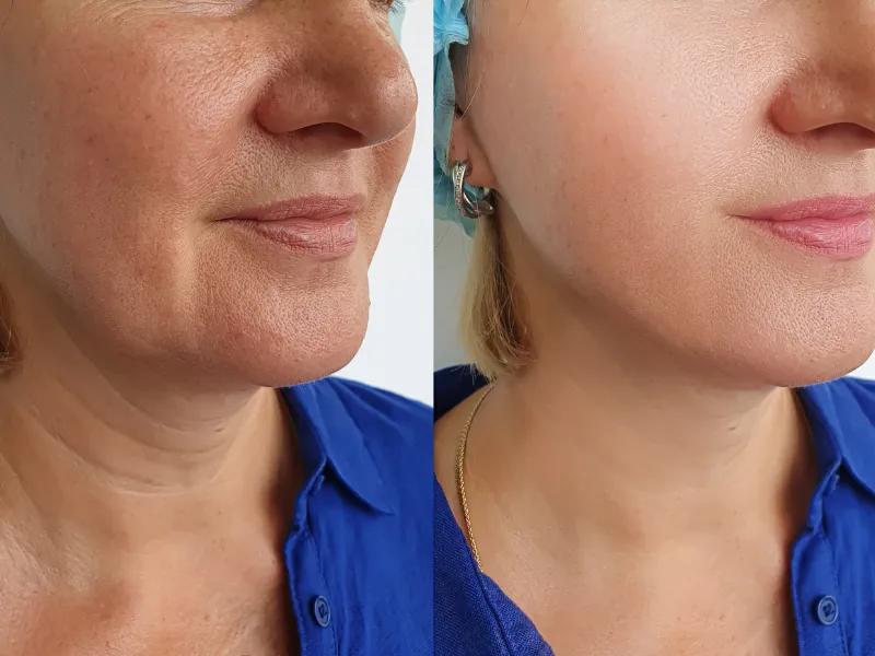 restylane before and after