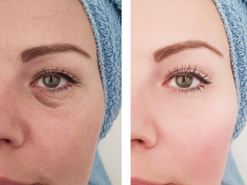 rf microneedling before and after