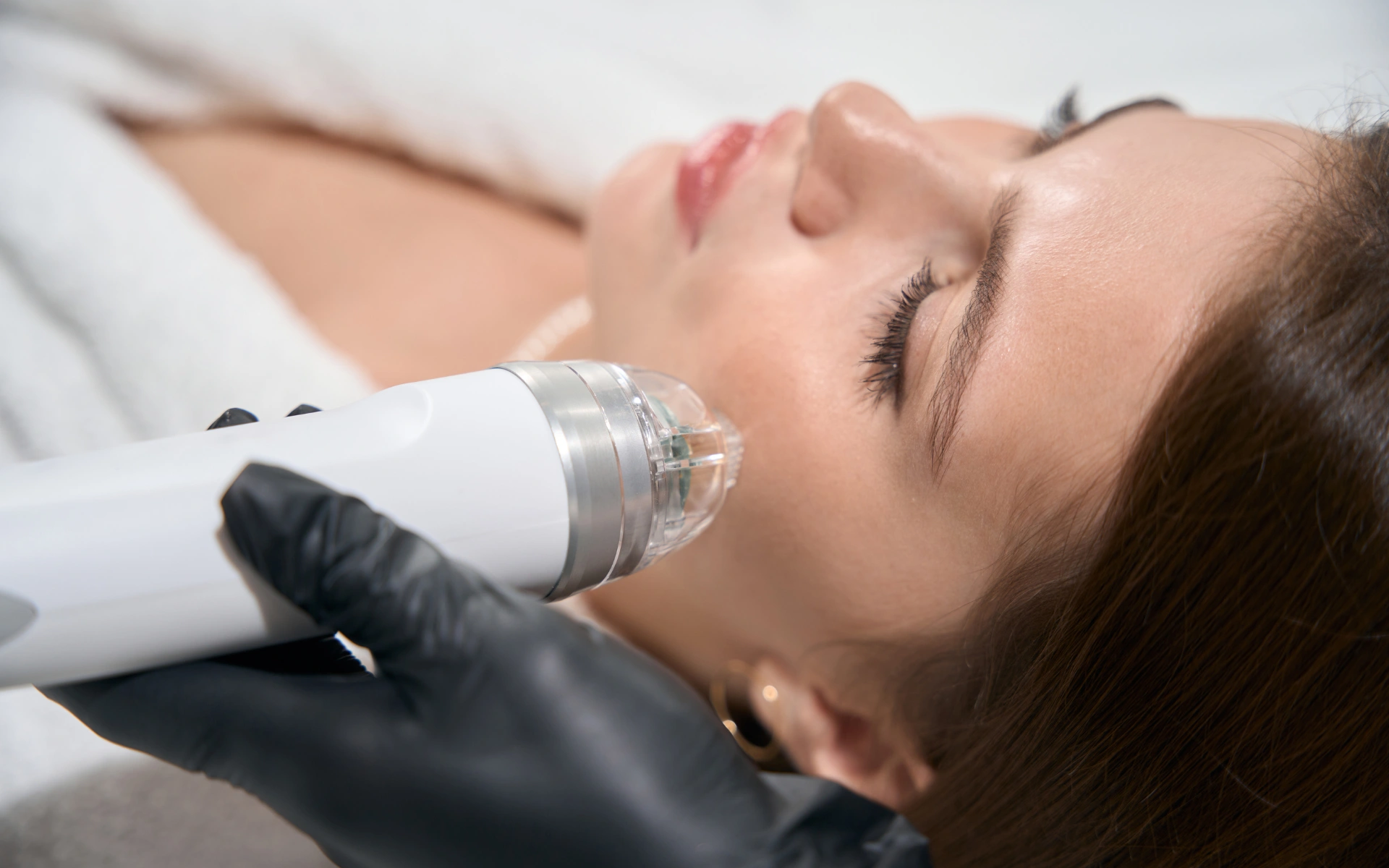 rf microneedling houston