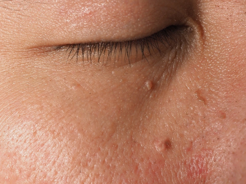 skin tag removal benefits