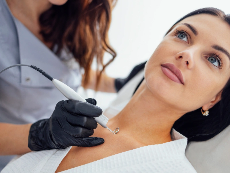 wart treatment